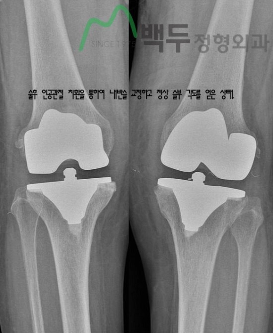 대구무릎관절 수술 추천 병원